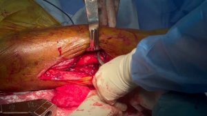 PFNA LONG ПРОТИВ 32В3