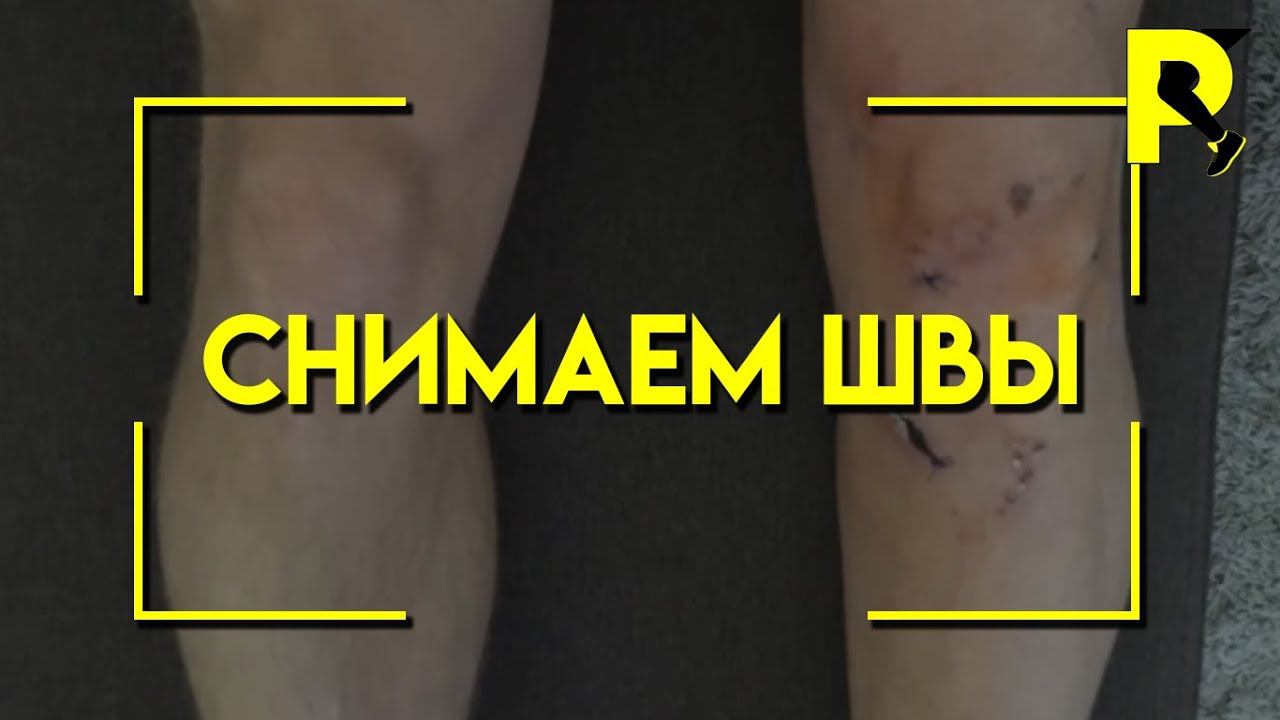 Снятие швов после пластики передней крестообразной связки (ПКС). 15 день после операции.