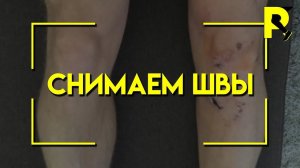 Снятие швов после пластики передней крестообразной связки (ПКС). 15 день после операции.