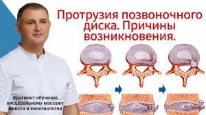 Протрузия позвоночного диска. Причины возникновения. Фрагмент обучения