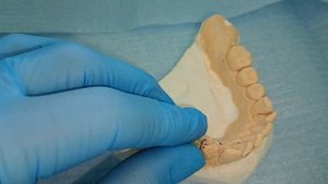 протезирование