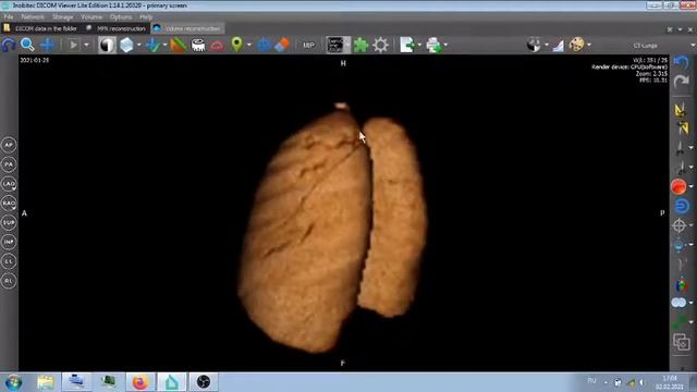 КТ легких после пневмонии с последствиями . смотреть онлайн