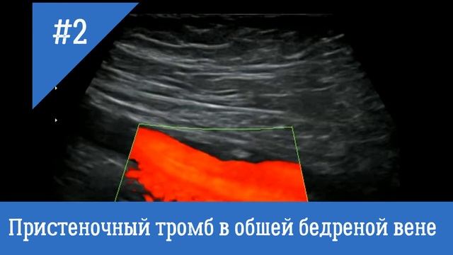 УЗИ сосудов. Пристеночный тромб в общей бедренной вене