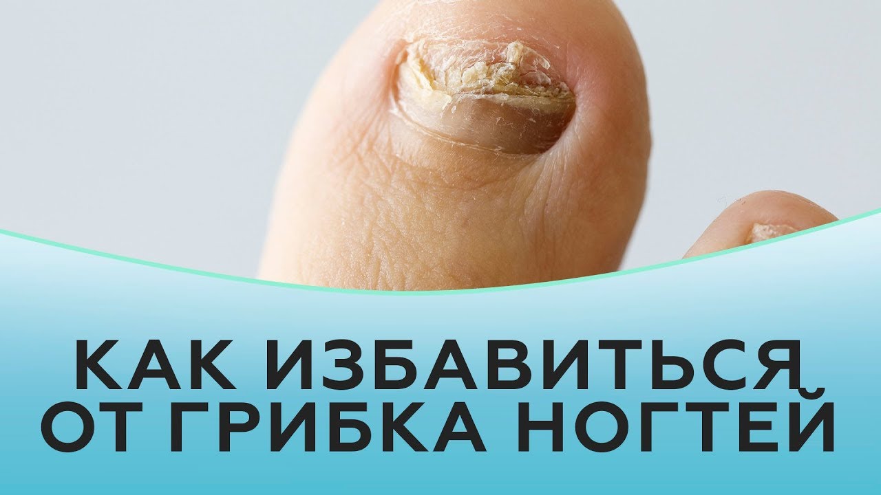 Как избавиться от грибка ногтей смотреть онлайн
