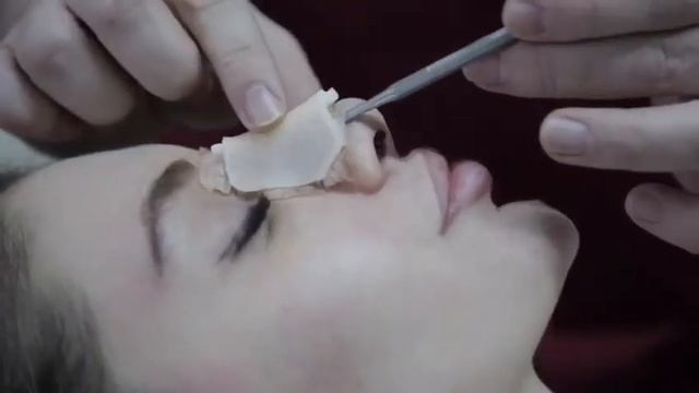 Ринопластика