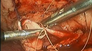 Лапароскопическая пиелопластика, модификация Gonzalez.mpg