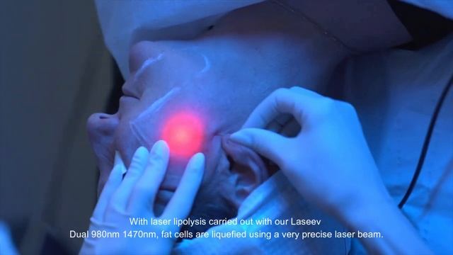 Get ready to lift and rejuvenate your skin with Endolift Laser treatment