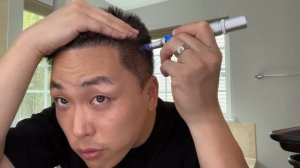 MY MICRONEEDLING ROUTINE TO TREAT HAIR LOSS!