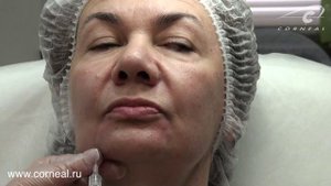 Как убрать залом на подбородке?