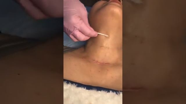 Процедура мезопилинга аппаратом Ablase ⚡️ смотреть онлайн