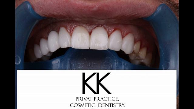 КЕРАМИЧЕСКИЕ ВИНИРЫ , CERAMIC PORCILAIN VENEERS смотреть онлайн