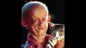 Редкая болезнь - Прогерия | История о пугающей болезни | Страшное неизлечимое заболевание.