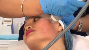 VIVACE MICRONEEDLING TREATMENT FOR SKIN LIFTING