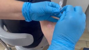 Дерматофиты: Соскоб с локтя