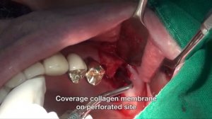 150204 Maxillary Sinus Crestal approach of sinus graft using INNO, S Kit and CowellBMP