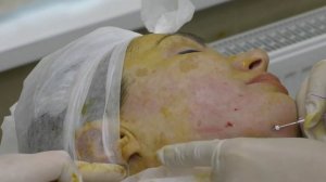 Постановка нитей EPITICON (Jetema, Южная Корея): лифтинг нижней трети.