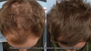 Димексид для роста волос: все способы эффективного использования этого препарата