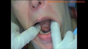 Протезирование на имплантах при полном отсутствии зубов.