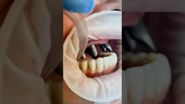 Непростой случай для имплантации зубов. A difficult case for dental implantation.