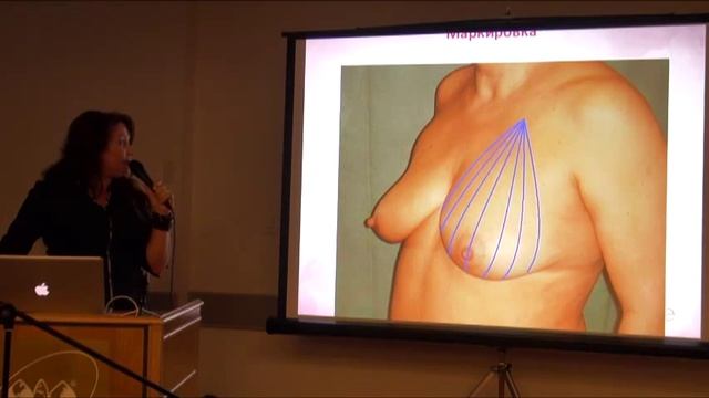 Light Lift Body новинка нитевых подтяжек Аптос. Газизулина