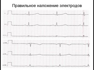 ЭКГ: неправильно наложенные электроды