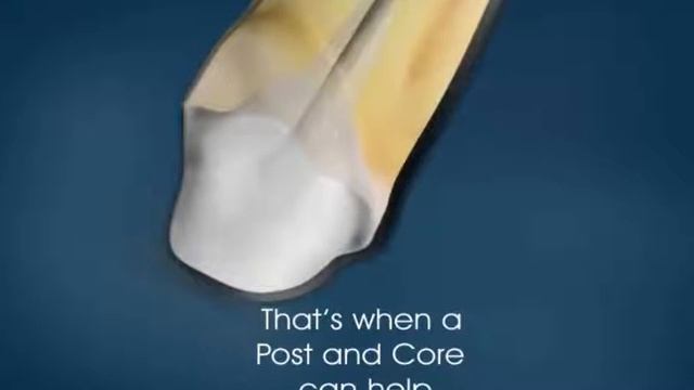 Эндодонтия - штифты смотреть онлайн