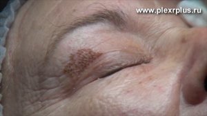 Солнечное лентиго - удаление с помощью аппарата Plexr Plus