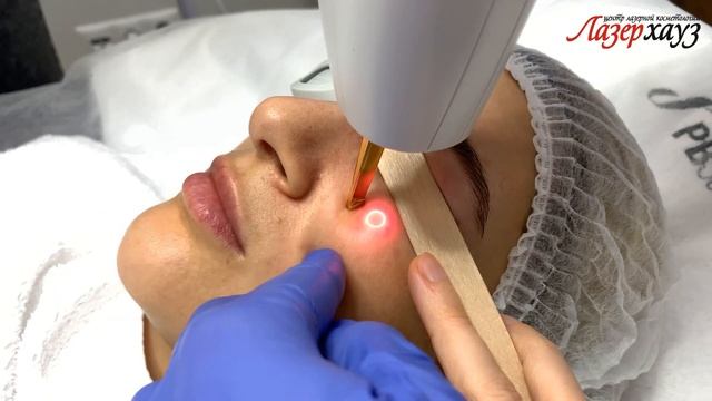 Лазерная блефаропластика на аппарате LUMENIS M22 смотреть онлайн