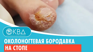 ? Околоногтевая бородавка на стопе Клинический случай №446
