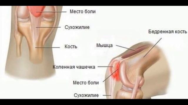 ✅ Болят колени что делать. Болят колени чем лечить. Колено опухло и болит
