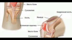 ✅ Болят колени что делать. Болят колени чем лечить. Колено опухло и болит