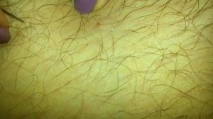 вросший волос / ingrown hair