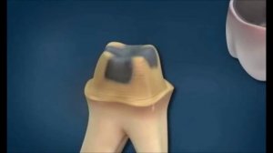 Сколько может простоять коронка? Когда следует коронку заменить? Уроки стоматологии