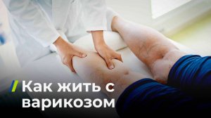 Как жить с варикозом