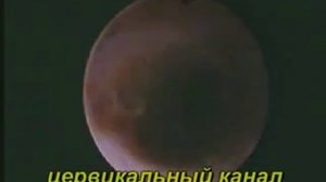 Вторичная аменорея из за спаек цервикального канала