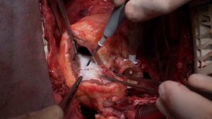 Бифуркационный гомографт правого желудочка