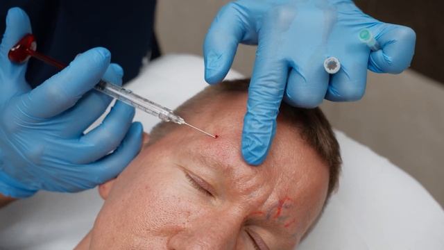 Коррекция верхней трети лица филлером Neauvia Stimulate смотреть онлайн