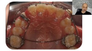 Live 109 -  Tratamento ortodôntico de uma transposição dentária bilateral de caninos superiores.