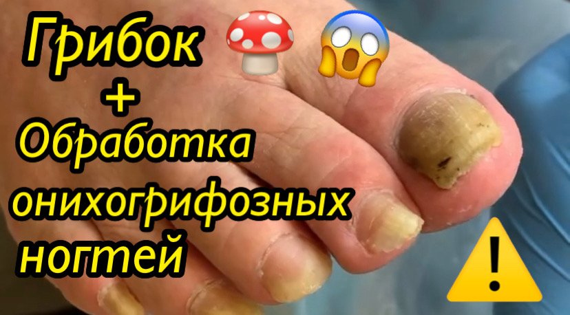 Грибок? + Обработка онихогрифозных ногтей⚠️?❗️??