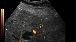 Киста печени