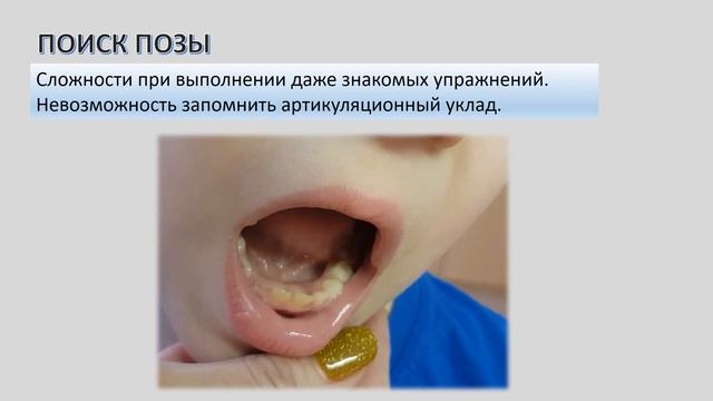 Дизартрия и ее признаки в артикуляции.