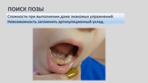 Дизартрия и ее признаки в артикуляции.