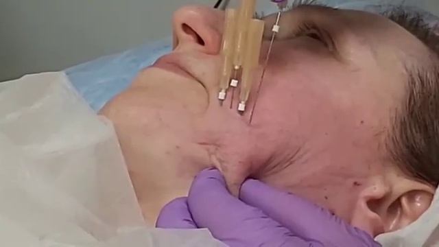 АирисКом студенты учатся: урок по мезонитям. Коррекция нижней части лица, брыли.