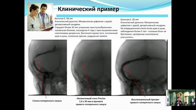 Васильев А Э Эндоваскулярная коррекция венозной гиперволемии синусов головного мозгав реализации