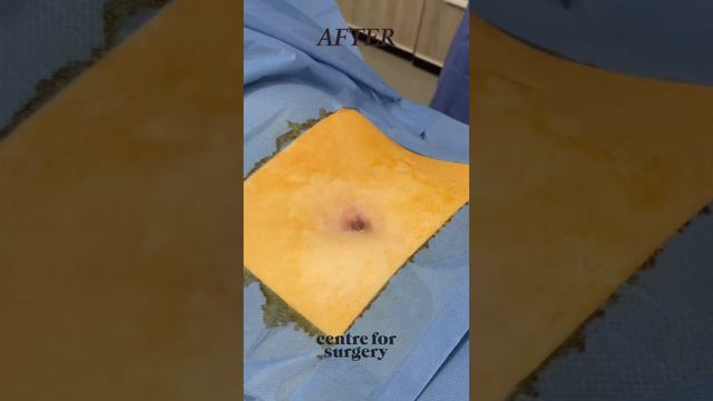 UMBILICOPLASTY BEFORE AND AFTER | LONDON UK | Centre for Surgery