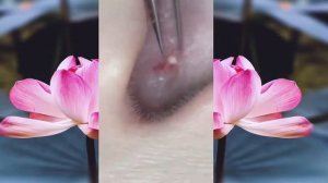 Выдавливание чёрных точек НОВОЕ! Удаление чёрных точек за ухом. p27