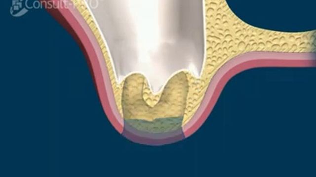 Sinus Atrophy Around Roots and Extraction Movie | Implants Pro Center© | San Francisco смотреть онлайн