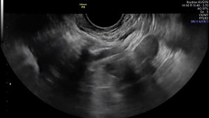 Эхо-ГСГ (Эхогистеросальпингография)..mp4