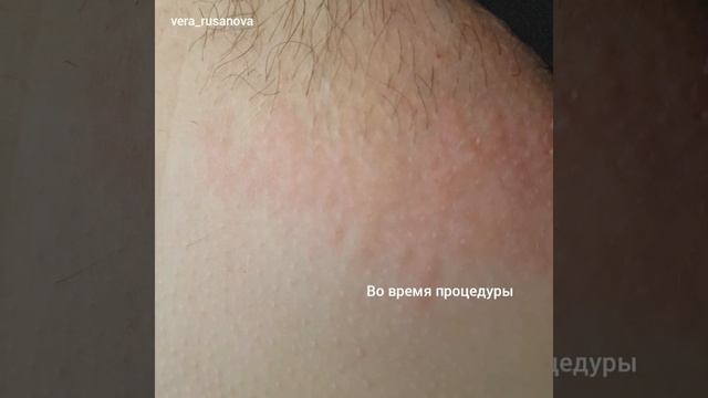 Электроэпиляция Ростов