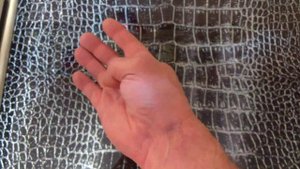 Год спустя. Порез сухожилия сгибателя пальца. | © 2015